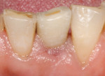 Implants and restorations placed in unfavorable positions. Final restoration with compromised esthetics.