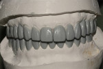 Fig 7. Wax-up at increased VDO (Fig 7) and eliminating the discrepancy in the occlusal plane (Fig 8).
