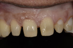 Fig 13. Conservative maxillary tooth preparations in enamel.