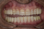 Fig 12. Reduction grooves made through the provisional restorations to minimize tooth reduction.