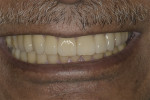 Fig 24. Post-treatment smile.