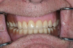 Figure 1  The patient´s existing dentures were loose and had worn teeth and severely decreased vertical dimension.