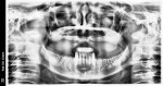 Preoperative panoramic radiograph of the patient’s edentulous maxilla.