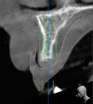 Initial CBCT scan demonstrating minimal bone availability for implant placement.