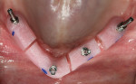 Screw-retained bite rims made to establish vertical dimension of occlusion.