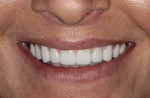 Final smile view of the fixed zirconia prosthesis.