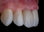Fig 8. Multilayer zirconia can offer exceptional monolithic esthetics and predictable processing from diagnostic to final.