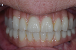 Fig 13. This provisional is made from Temp Esthetic Transitional PMMA from Harvest Dental.