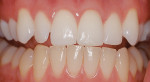 Bleaching only one arch demonstrates the change to the patient when the bleached maxillary arch is compared to the unbleached mandibular arch. Figures 1, 4, and 5 were previously published in Haywood, VB. Tooth Whitening: Indications and outcomes of
Nightguard Vital Bleaching. Chicago, IL: Quintessence; 2007 and reproduced with permission.
