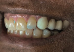 A provisional canine restoration made from bis-Acryl does not exhibit the gloss of the adjacent fixed partial denture or teeth.