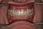 Fig 7. Indirect provisionals were added to the natural teeth and implants based on the diagnostic wax-up.