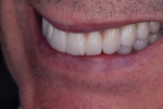 Fig 17. The final restorations meet all of the patient’s requirements for esthetics and function.