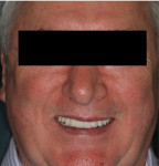 Fig 1. The 64-year-old patient is unhappy with his dental esthetics, especially the bright white teeth, as he feels they are no longer age-appropriate.