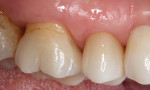 Final restoration at 14-month follow-up appointment, exhibiting excellent adaptation and function.