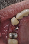 Fig 8. Final placement of immediate implant with grafting of buccal gap using particulate allograft.