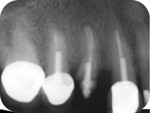 Fig 12. Pretreatment radiograph of nonrestorable maxillary right first premolar.