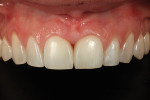 The 2-day postoperative photograph shows how nicely the single-shade universal composite blends with surrounding color and texture of the natural enamel.
