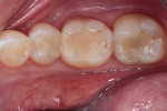 The patient presented with staining, recurrent caries, and ditched margins on teeth Nos. 30 and 31.