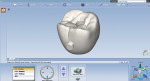 Fig 18. The lab electronically returned a CAD design of the crown (Fig 18), along with a titanium abutment for insertion (Fig 19). The crown was milled and finished in-office. Note the excellent marginal fit of the
crown on the abutment (Fig 20).