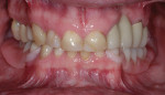 Preoperative retracted view with the removable partial denture.