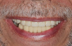 A functionally stable and esthetic result was achieved that satisfied the patient.