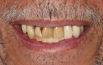 Fig 1. The patient presents with periodontally involved nonrestorable maxillary teeth.