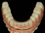 Fig 10. The fixed lower prosthesis and titanium substructure are made with nano-hybrid composite. The two parts are milled separately and bonded, and the gingival area is covered with composite before the final product is polished and glazed for delivery.