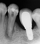 Root canal dressing with calcium hydroxide in place for 15 days.