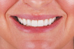 Fig 12. The postoperative full-smile and full face photographs display the esthetic result achieved.