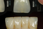 Figure 12  Anterior translucency modification was checked on the incisal third using the Chairside Shade Guide.