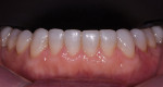 Fig 10. Postoperative, restoration of mandibular erosion, blending of composite to natural teeth, and leveling of mandibular plane.