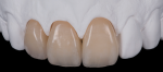 The innovative, multilayer technology of KATANA Zirconia discs from Kuraray Noritake is specialized for fabricating full-contour zirconia crowns. It is available in a full shade range, exhibiting natural color gradiation and high translucency, helping dental professionals achieve higher levels of esthetics.