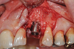 Fig 4. Healing abutment placed, and hard tissue augmented with freeze-dried bone allograft (FDBA).