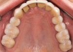 Figure 1  The patient’s oral rehabilitation was addressed in two stages. An overall comprehensive treatment plan was presented and the patient elected to proceed with the maxillary arch first, then the mandibular arch sometime in the near future.