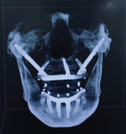 Fig 8. CBCT scan (cranial view) of restored case with zygomatic, pterygoid, vomer, and
standard dental implants.