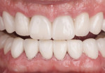 Fig 14. Discoloration masked with layered
3Y zirconia crowns.
