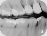 Preoperative radiograph of caries lesion on tooth No. 28.
