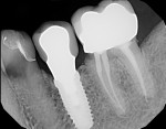 Fig 4 and Fig 5. Decay was present at margins of previous restorations on teeth adjacent to molar implants.