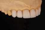 Fig 17. Evaluation of incisal effects after second “bisque” firing.