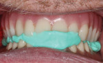A bite registration was used to verify the patient’s occlusion prior to curing.