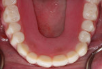 Retracted occlusal view of the seated overdenture providing form and function for the patient.