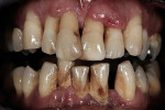 Figure 1  The patient presented with severe generalized periodontal disease and bone loss of existing teeth.