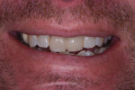 Postoperative smile photograph with the temporary restoration in place.