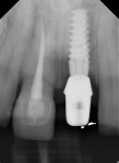 Periapical radiograph taken to confirm placement of the zirconia abutment.