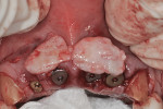 Fig 15. Palatal subepithelial CTGs harvested from premolar areas bilaterally and overlaid on the buccal aspects of the implanted sites. The CTGs were tucked under the tissues to cover the buccal walls of each implant and sutured to the undersurface of the flaps Nos. 7 through 10 with 6-0 plain gut sutures.
