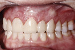 Fig 9. Teeth Nos. 6 through 11 temporized and tack-bonded in place.