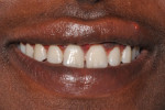 Fig 7. One-week postoperative follow-up, patient’s smile.
