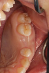 Fig 4. Post graft healing, occlusal view.