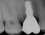 Fig 21. Periapical radiograph, prosthesis delivery.