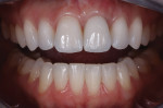 Posttreatment retracted view with the teeth apart showing the inserted porcelain restorations after complete healing had occurred.